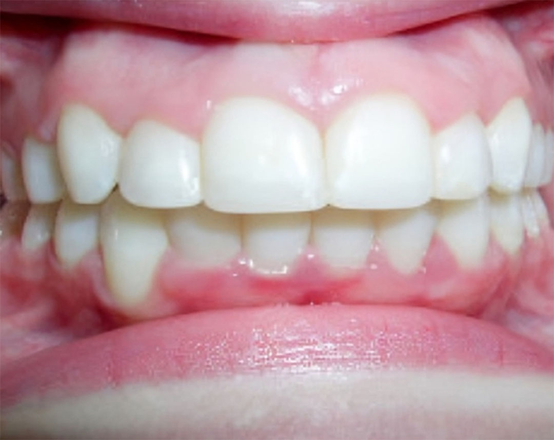 Orthodontic Treatment in Redding CA